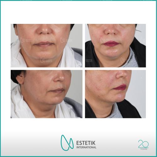 Estiramiento facial no quirúrgico Fotos del antes y el después